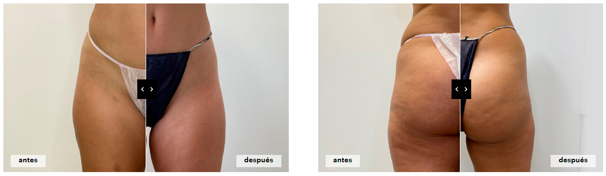 antes-despues